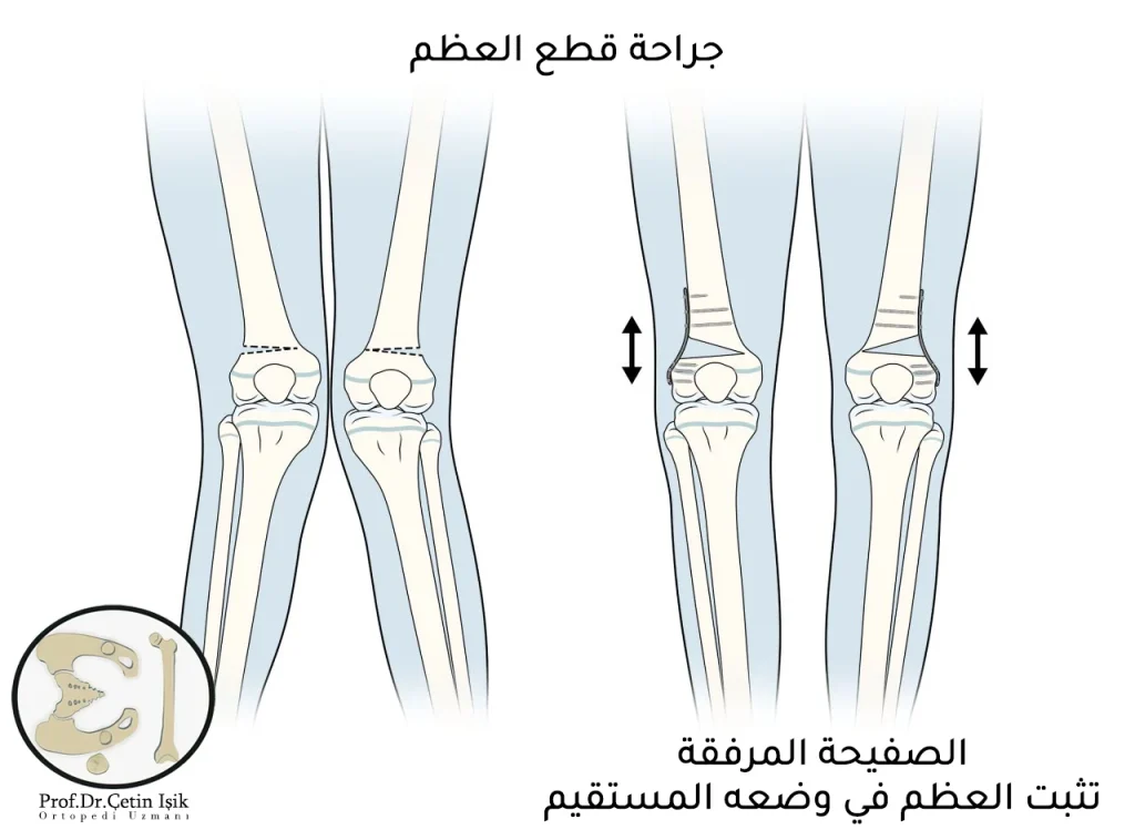 بعد قطع العظام بزاوية معينة تزرع صفائح لتعود الساقين في وضع مستقيم.