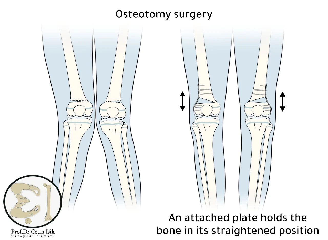 After cutting the bones at a certain angle, plates are implanted to return the legs to a straight position.