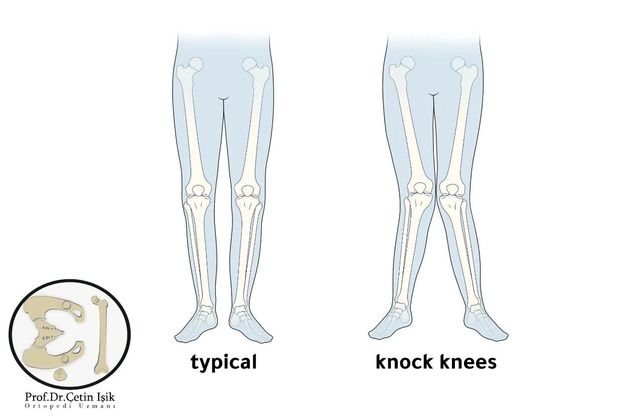The difference between the knee and the natural, we note the contact of the knees with the formation of a space between the ankles when standing