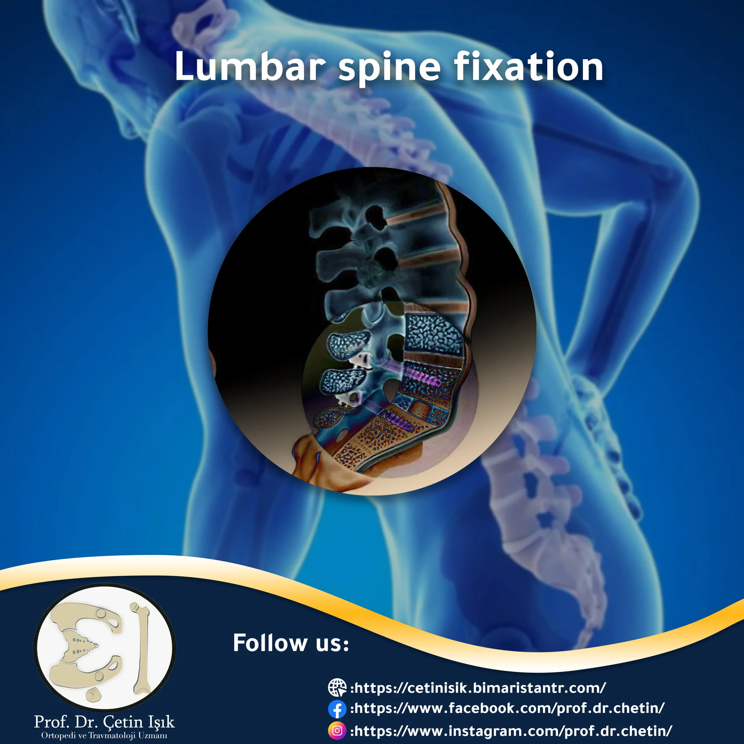 Lumbar spine fixation surgery to straighten the back