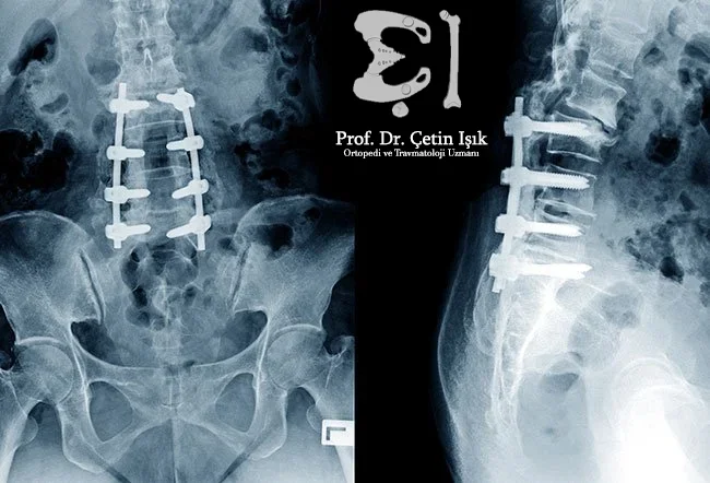 From the radiograph, we can see the screws and rods that secure the third, fourth, and fifth lumbar vertebrae, and the first sacral vertebra after the lumbar fixation operation.