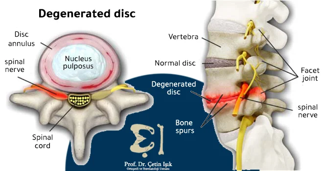 We note the degeneration of the herniated disc and the compression of the roots of the spinal nerves
