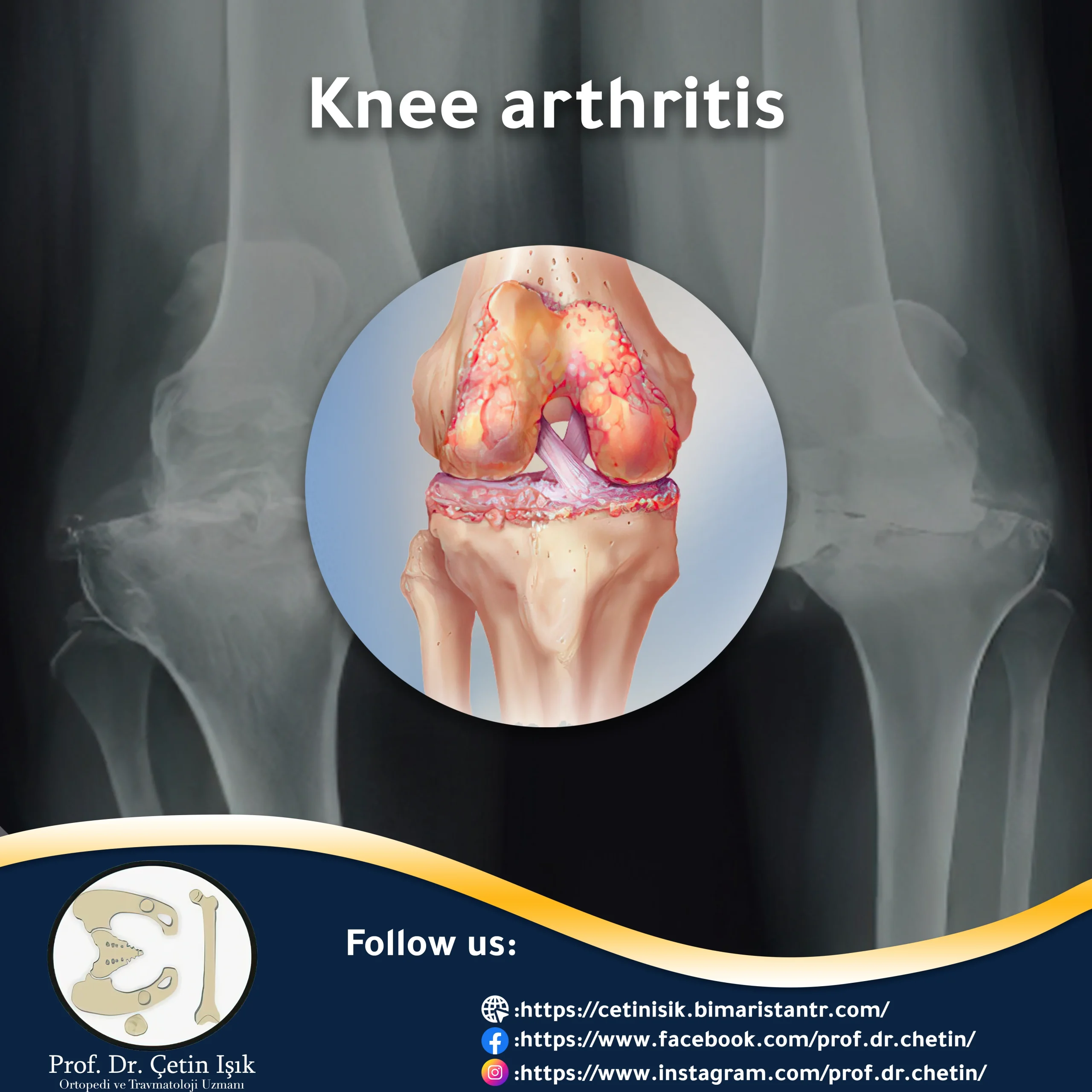 Knee arthritis and the most prominent methods of treatment