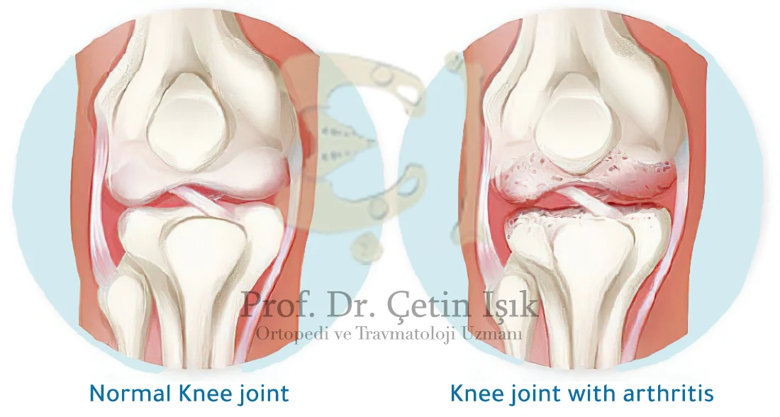 The difference between an inflamed and normal joint 