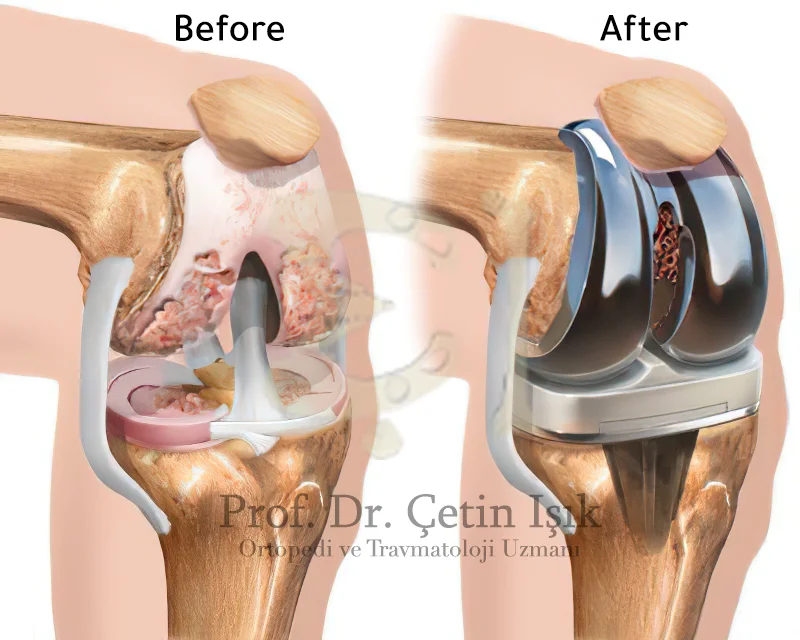 Replacement of the damaged knee joint with an artificial one