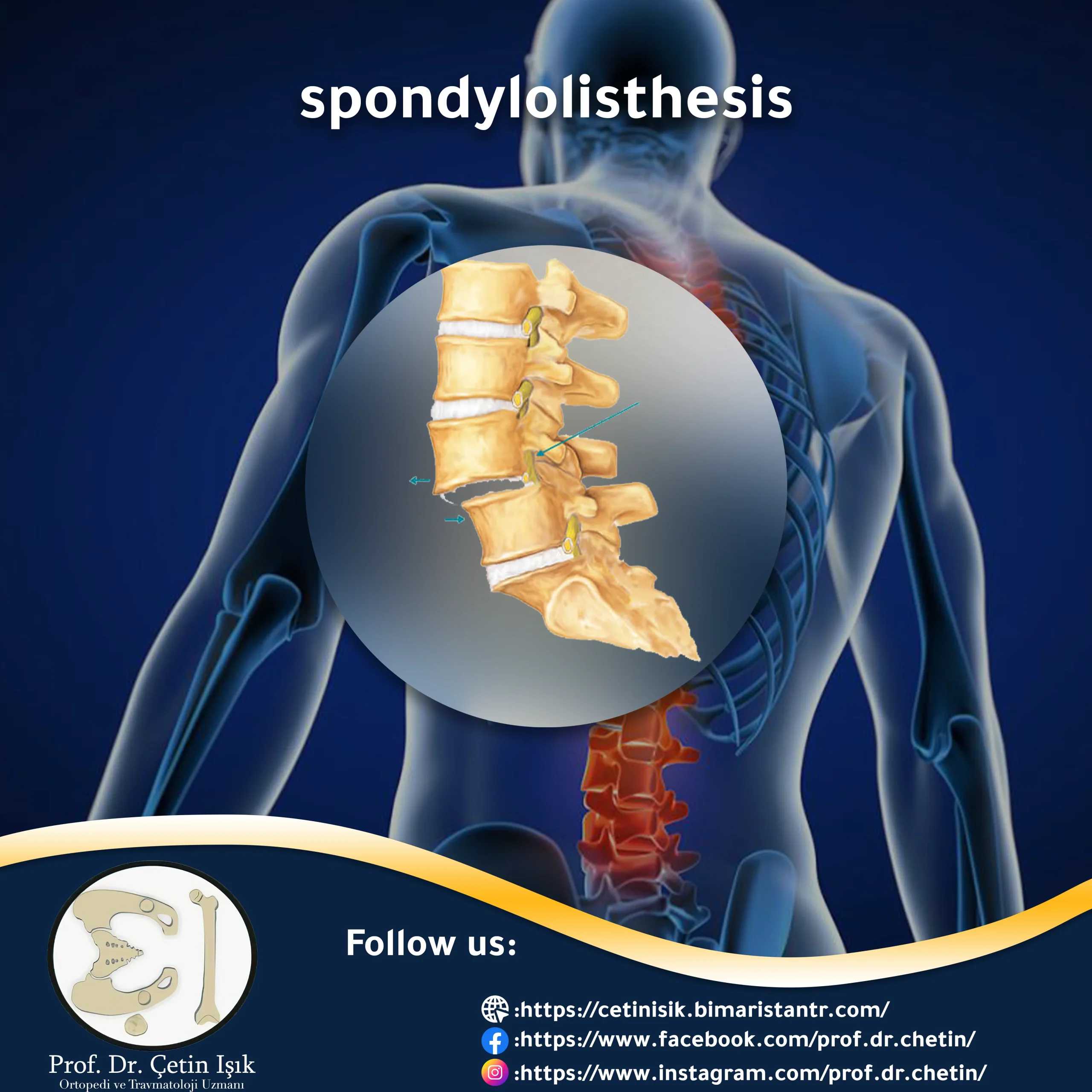 All you need to know about slipped back vertebrae