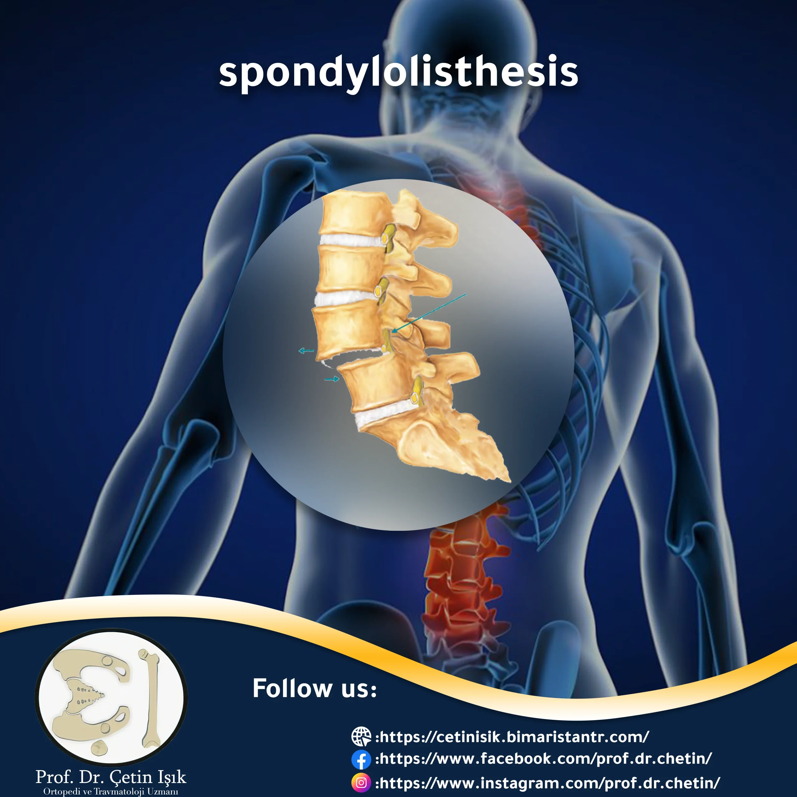 Protect Your Spine: What You Need to Know About Herniated Discs