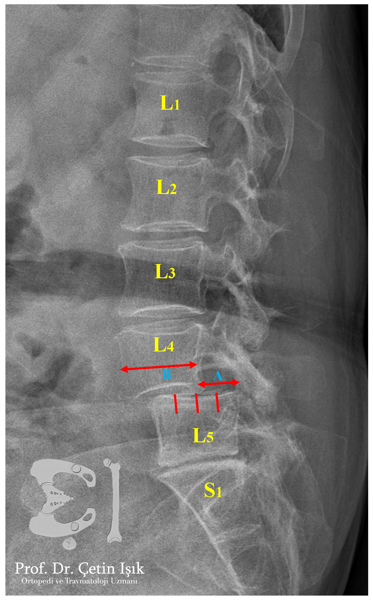 The radiograph shows the sliding of the fifth lumbar vertebra from the upper four lumbar vertebrae.
