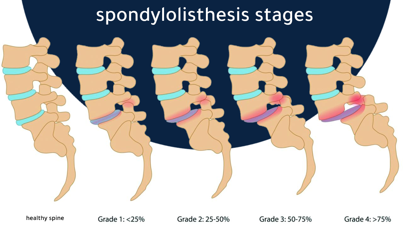 We can see from the picture the difference between a healthy spine and the four degrees of spondylolisthesis