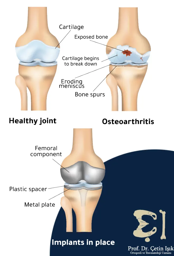 Image showing knee replacement surgery
