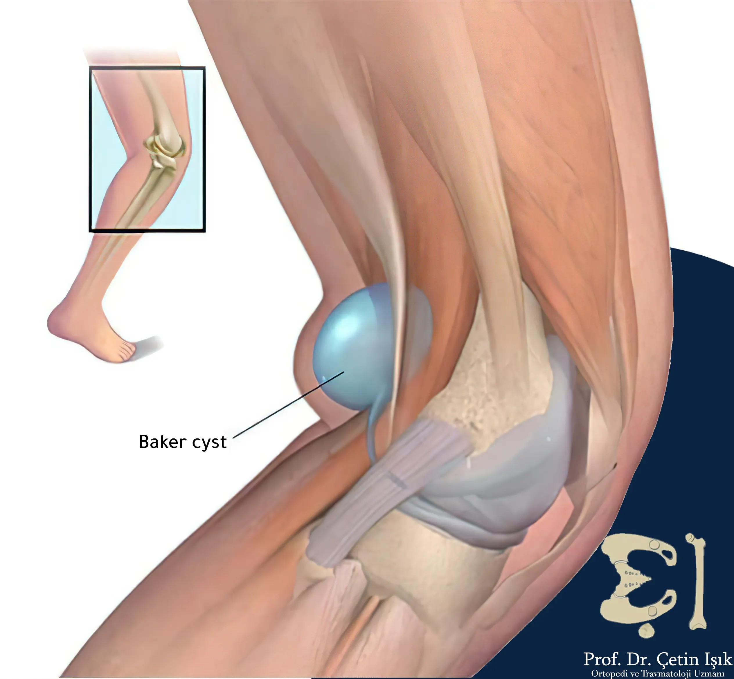 Baker's cyst is located at the back of the knee