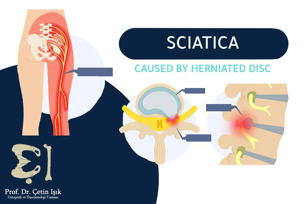 Where sciatica pain spreads, we notice its spread to the leg