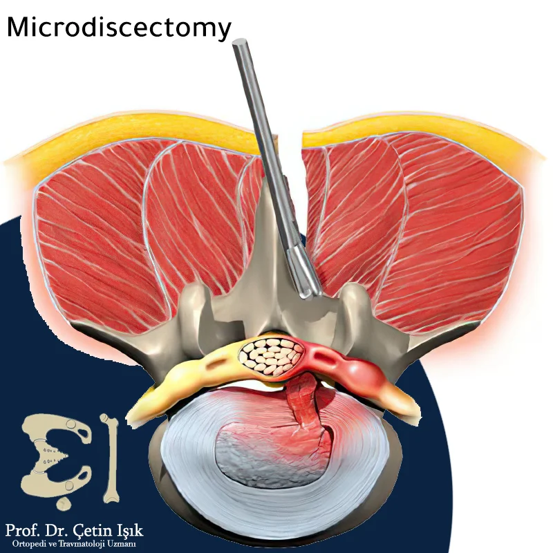 Note that a small incision is made during the disc microsurgery.