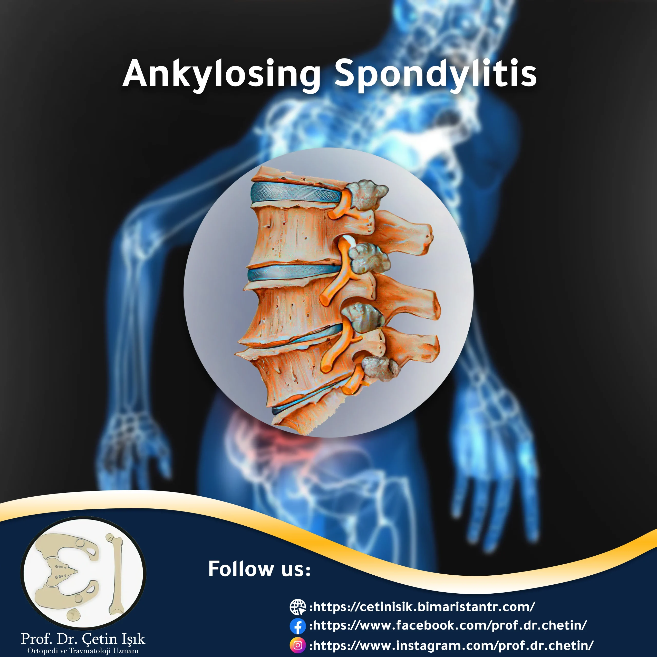 Picture of ankylosing spondylitis article