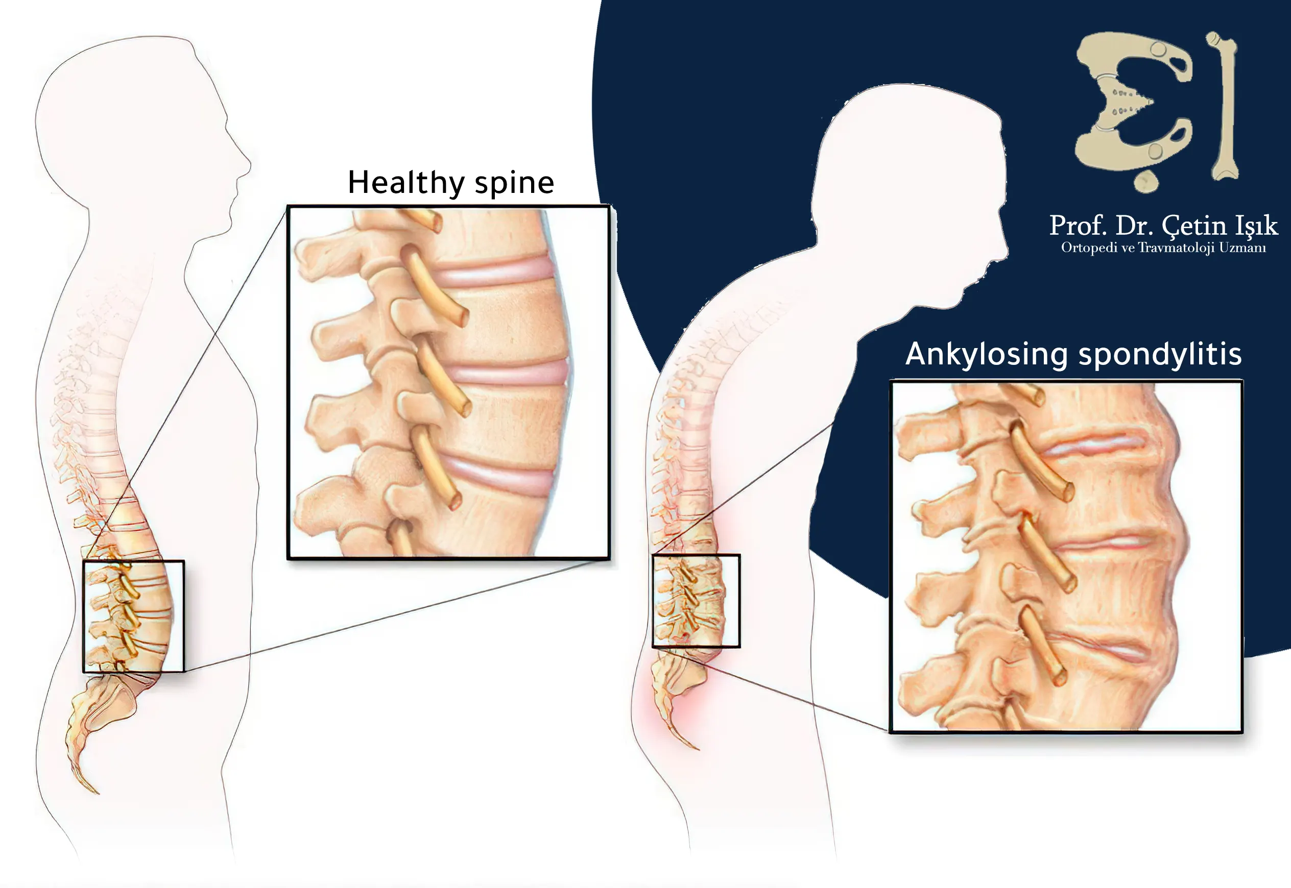 We note the formation of bones and sclerosis of the spine in ankylosing spondylitis
