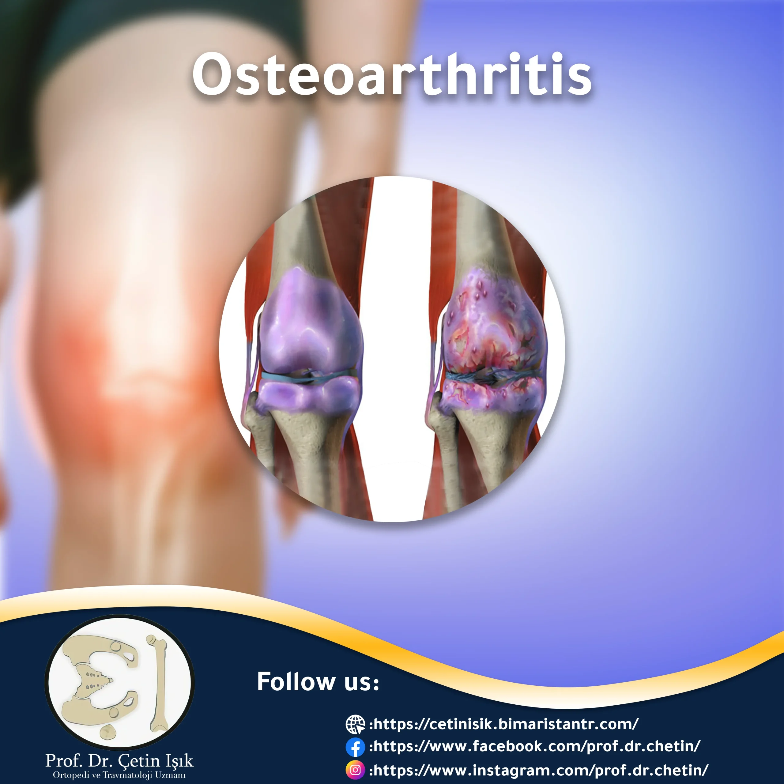 Image showing osteoarthritis