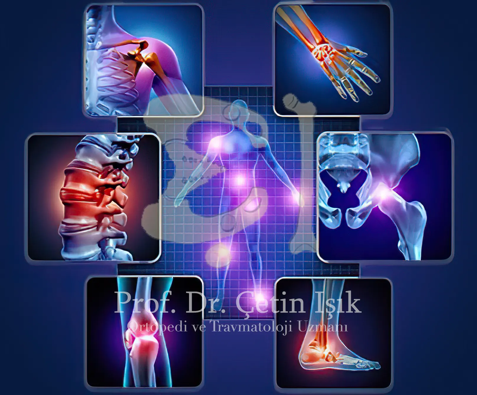 Image showing joints affected by osteoarthritis