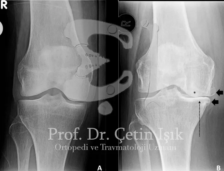 X-ray imaging of osteoarthritis