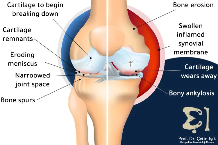 Image showing the joint affected by osteoarthritis