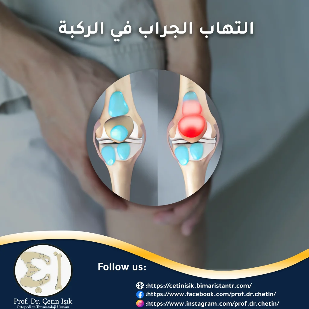 صورة توضح التهاب الجراب في الركبة وكيفية علاجه حيث لا تكون هذه الحالة عرضية عادةً وعندما تسبب أعراض تتركز في الرضفة ومفصل الركبة وقد ينتشر الألم نحو الأعلى أو الأسفل.