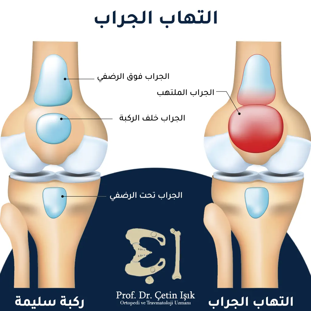 صورة توضح التهاب الجراب في الركبة والمكان الشائع الذي يسبب الألم ضمنه حيث يشيع انتشار الألم للأمام والأعلى