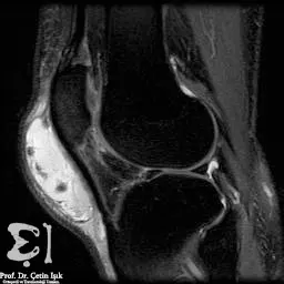 صورة بالرنين المغناطيسي توضح التهاب الجراب فب الركبة في مرحلة متقدمة حيث يُلاحظ تجمع القيح والسوائل ضمن الحيز المفصلي تحت الرضفة