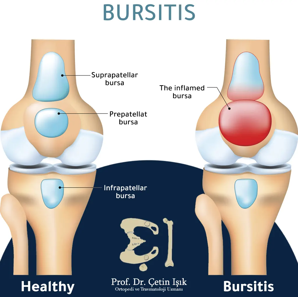 Image showing knee bursitis and a common location within which it causes pain as the pain commonly radiates forward and upward
