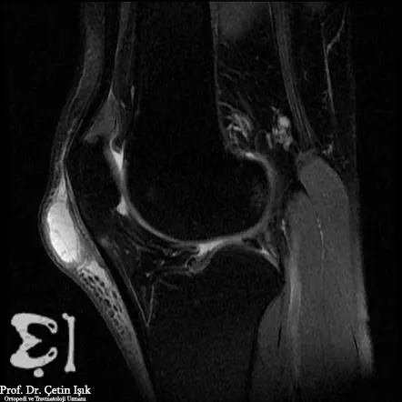 صورة رنين مغناطيسي للساق التي تعاني من التهاب الجراب في الركبة في مراحله المبكرة حيث يشعر المريض بالالم ولكن لا توجد وذمة أو انتفاخ ملحوظ في القدم