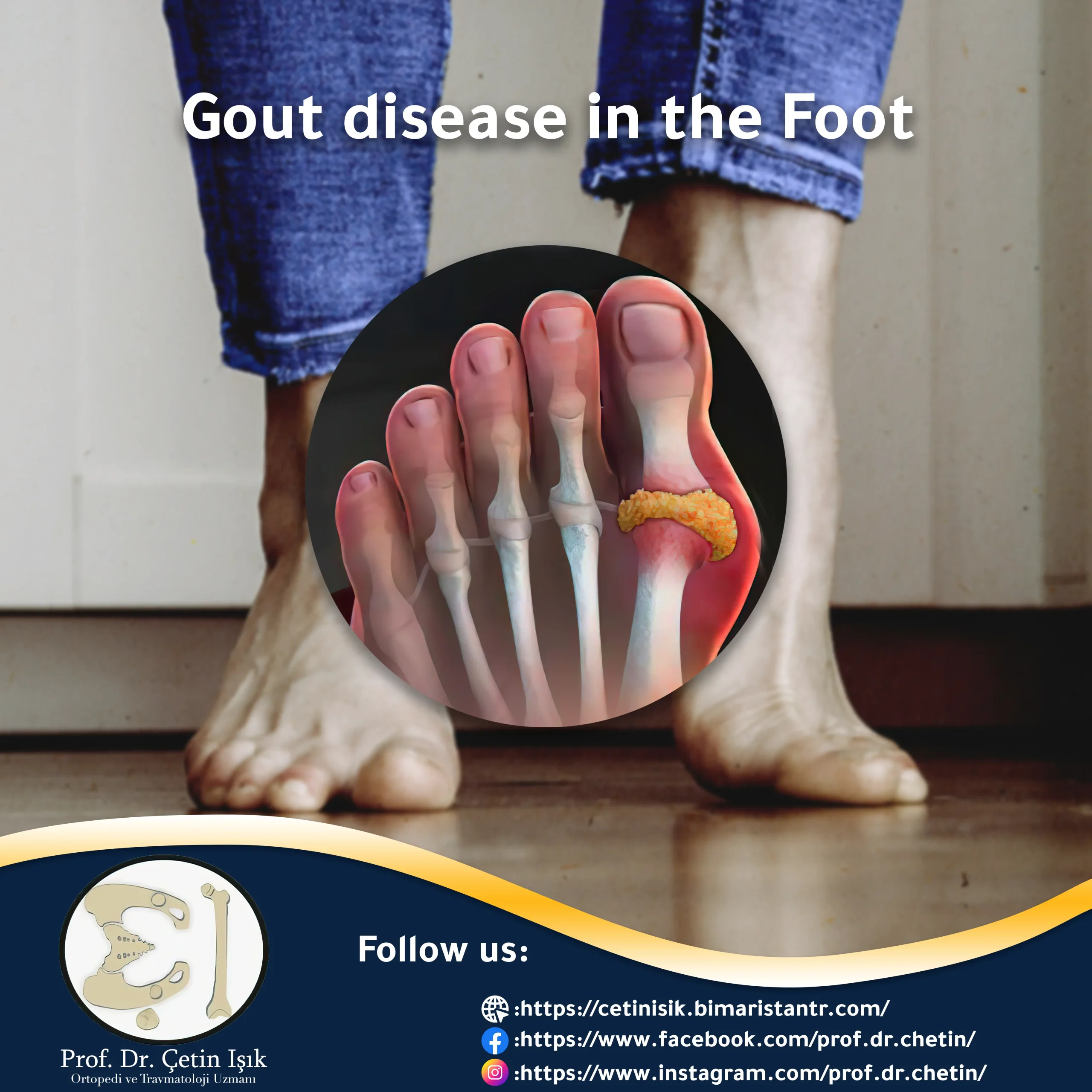 A picture of gout in the foot