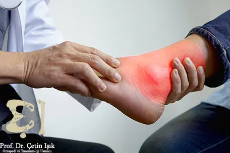 How to check for gout in the foot 