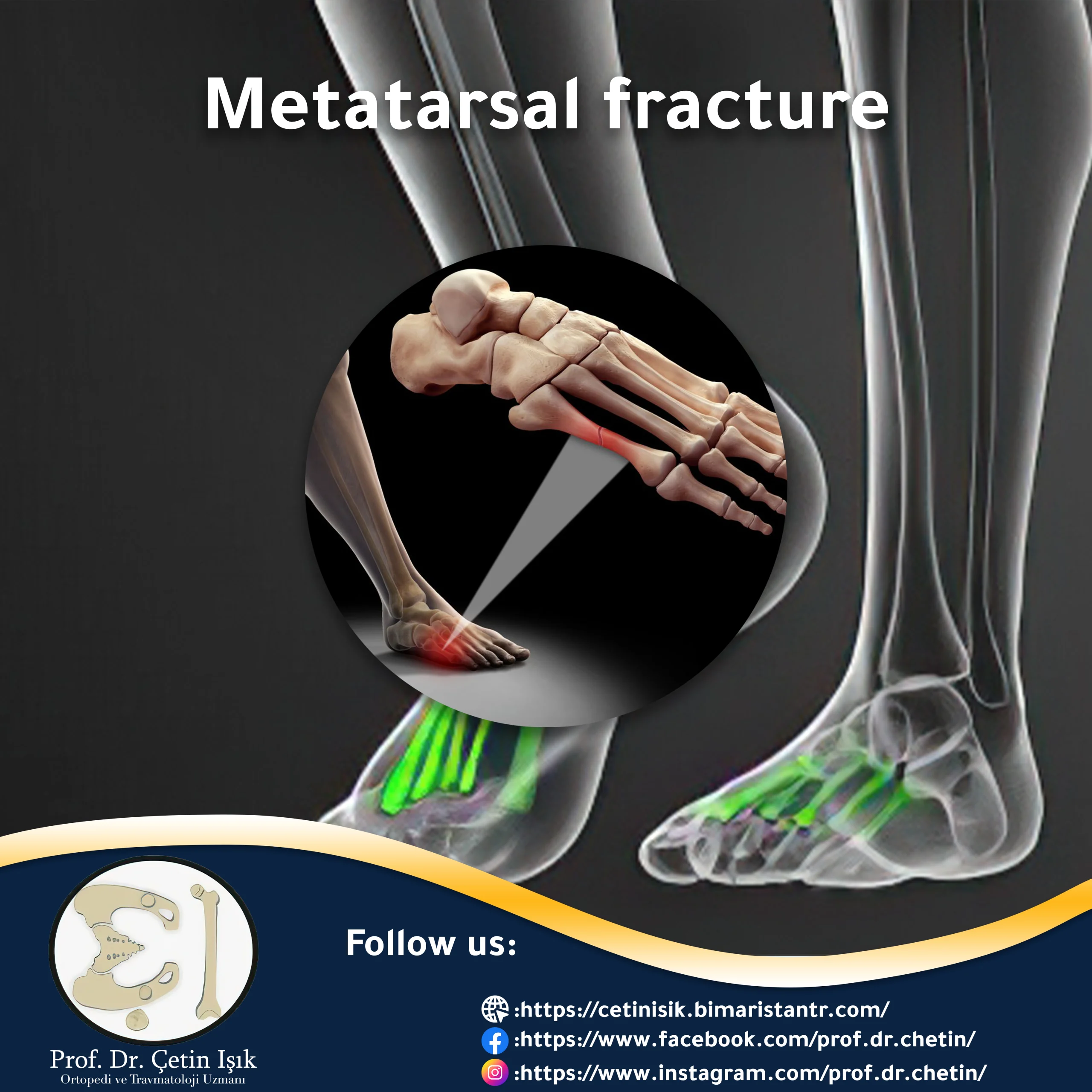 Metatarsal fracture from diagnosis to treatment