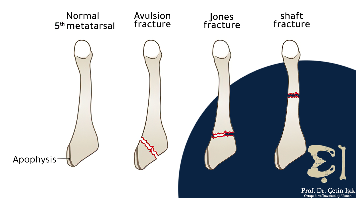 In the picture, we notice the difference between the normal metatarsal and the fracture of the corpus callosum, the Jones fracture, and the avulsion fracture. Where the avulsion fracture is at the bottom of the metatarsal near the base of the metatarsal and occurs in which the broken part has moved away from the site of the fracture, while the Jones fracture occurs at the base of the metatarsal without the fractured part erupting