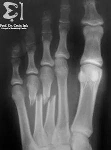 A simple X-ray shows a fracture of the third and fourth metatarsals