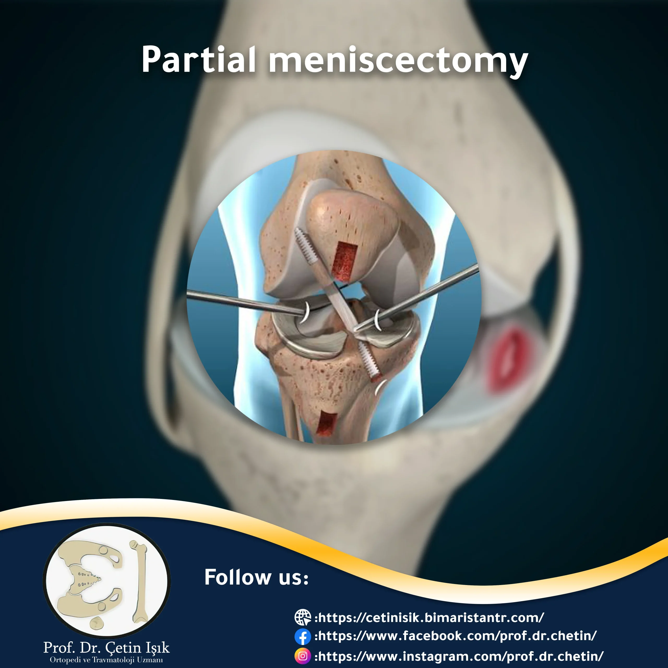 Image of knee meniscus resection, which is usually done arthroscopically and is a quick, non-invasive procedure
