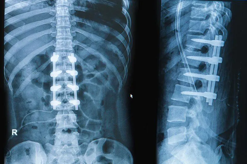 A radiograph showing the thoracic and lumbar vertebrae after placing special screws to fix them