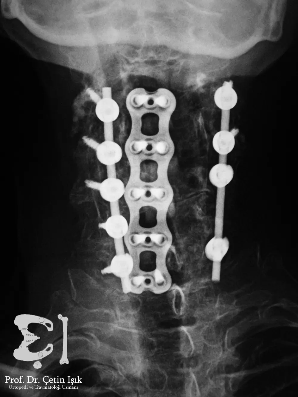 An image showing the method of stabilizing the vertebrae using screws, slides or metal plates