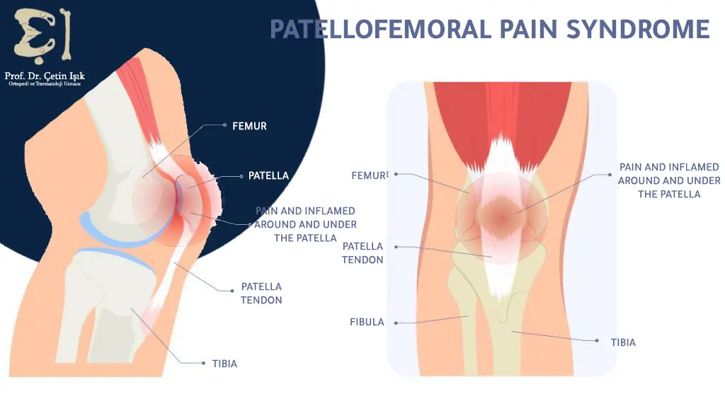 The image shows the anatomy of the knee and the placement of patellofemoral pain.