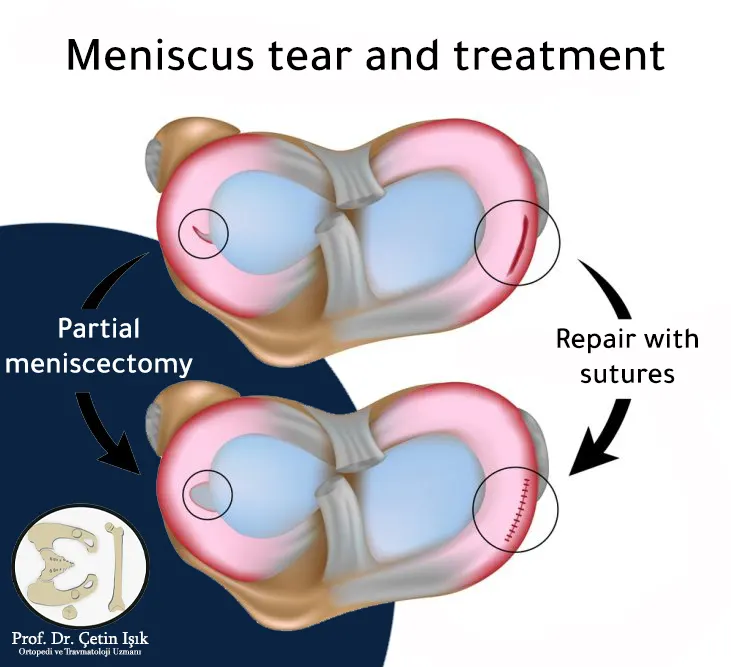 Image illustrating the surgical techniques used in meniscus repair with sutures with sutures and sutures without sutures