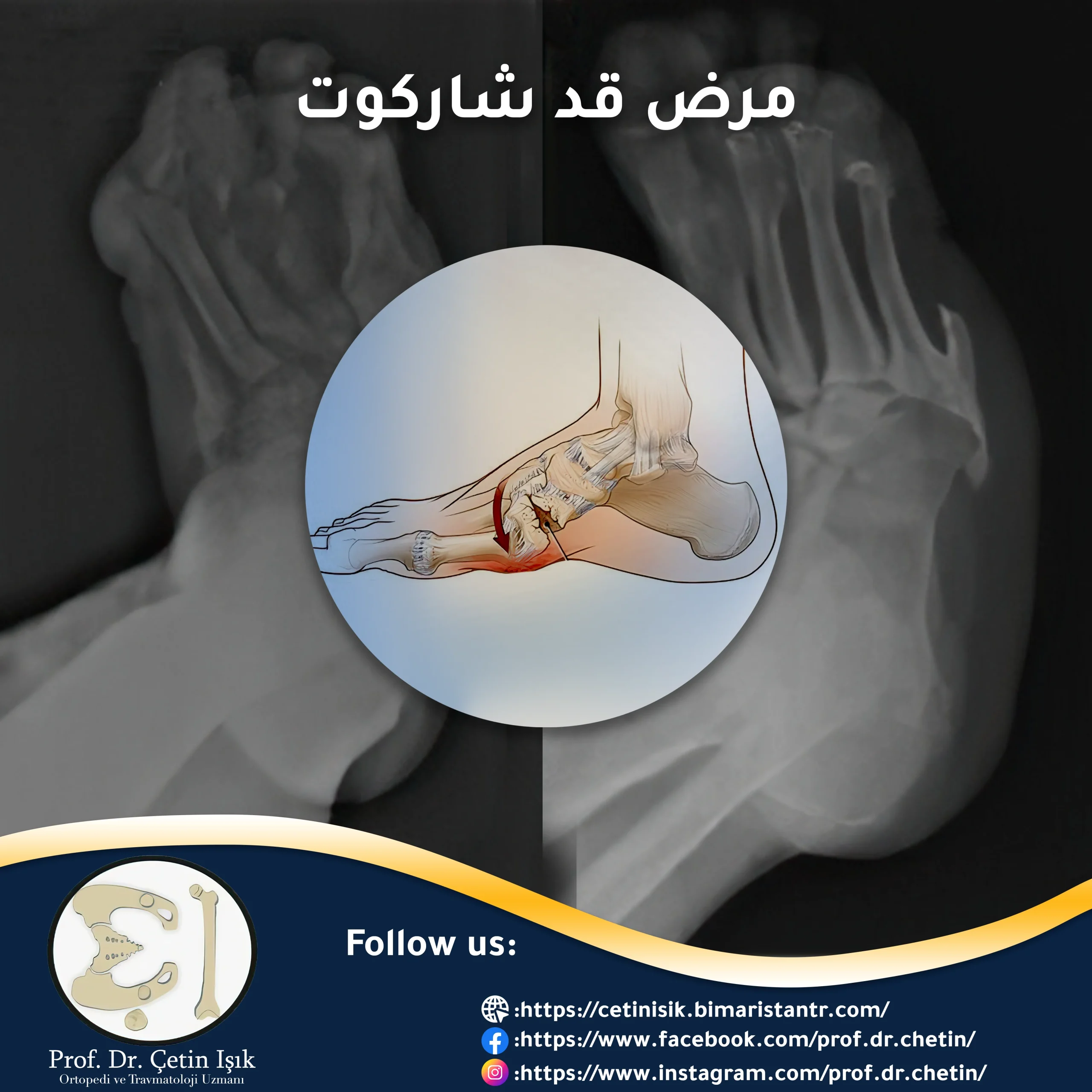 Charcot's foot disease; The most important causes and methods of treatment