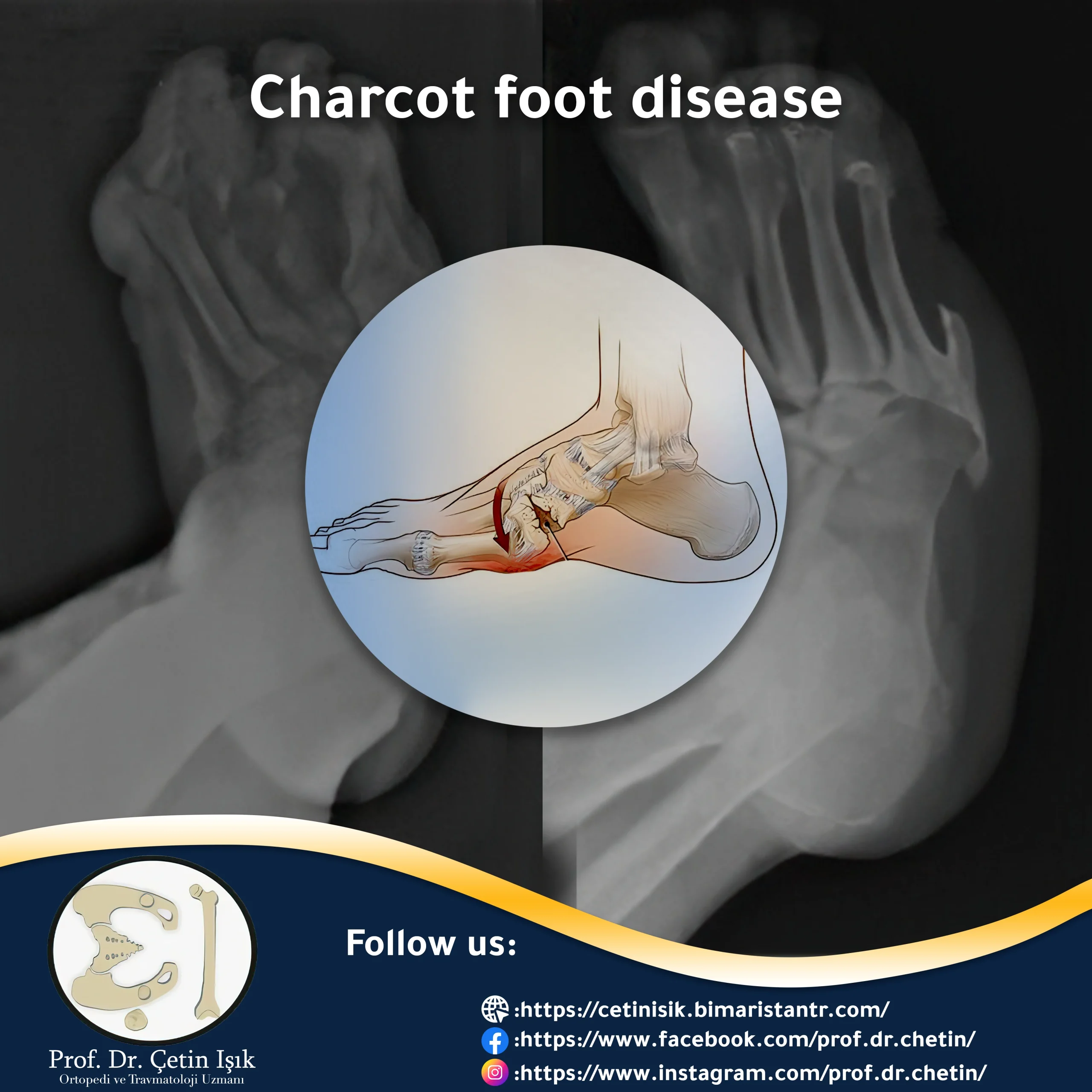Charcot's foot disease