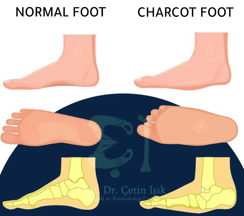 The difference between a normal foot and a Charcot foot is the collapse of the medial arch of the foot