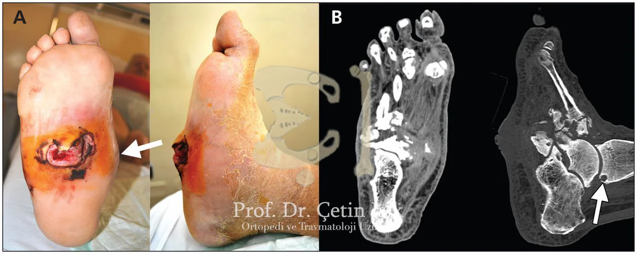 We can see the swelling, collapse of the medial arch and the formation of ulcers in Charcot's foot