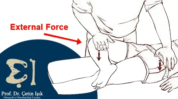 In the Faber test, an external force is applied to the knee after it has been flexed to the opposite end