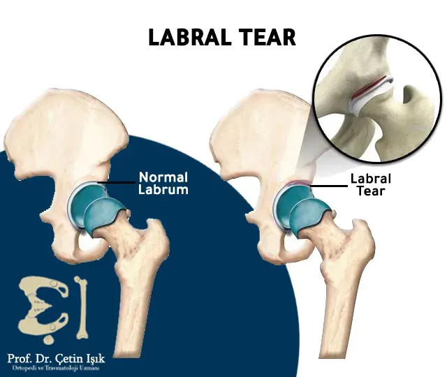 The difference between the normal and injured labrum, where tears appear in the labral tissue surrounding the acetabular cavity.