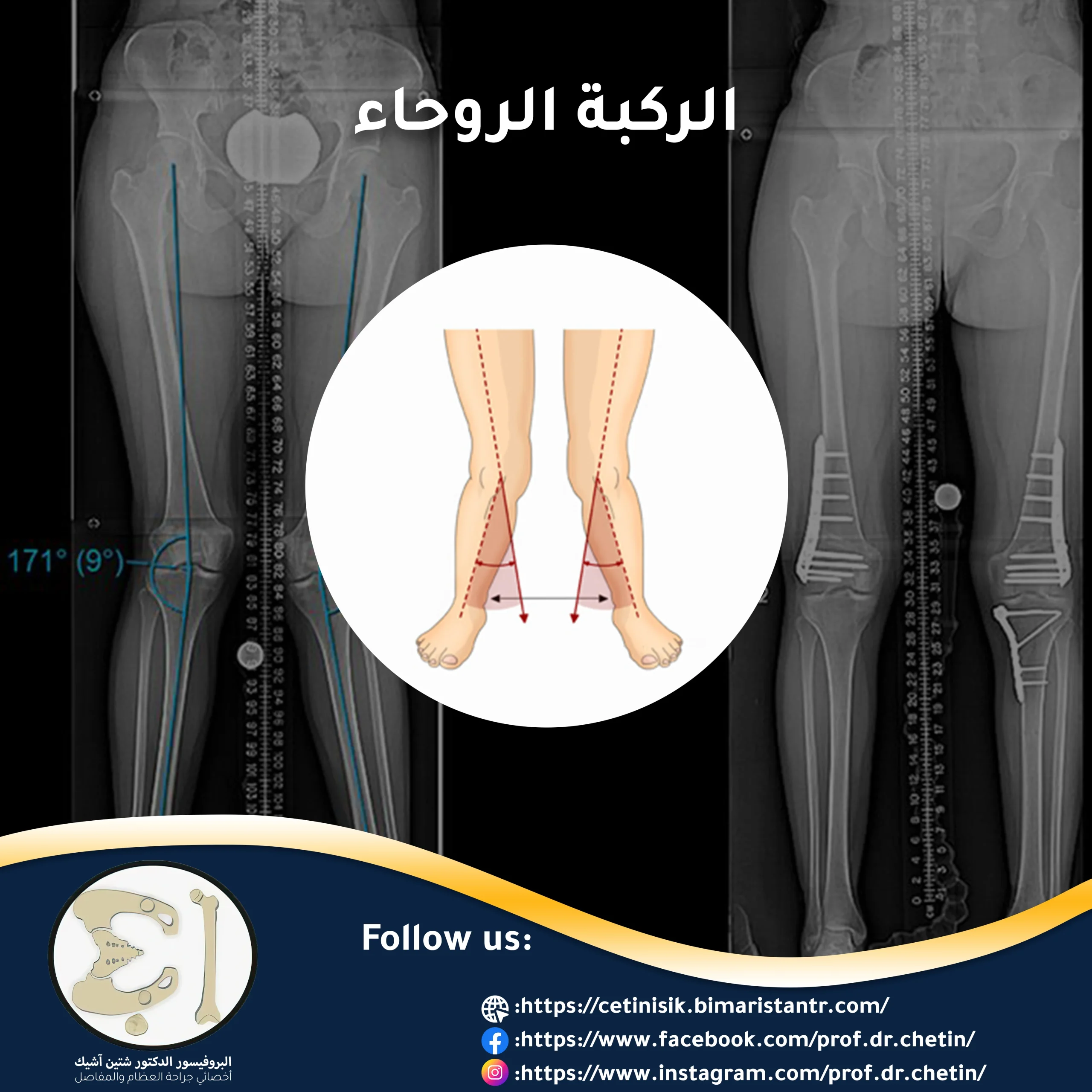 Knee-knock main symptoms and methods of treatment