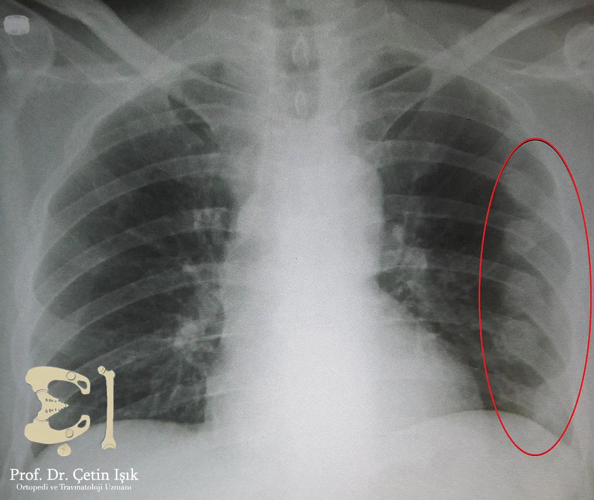نلاحظ من الصورة الشعاعية وجود عدة أضلاع مكسورة في الجانب الأيسر للقفص الصدري