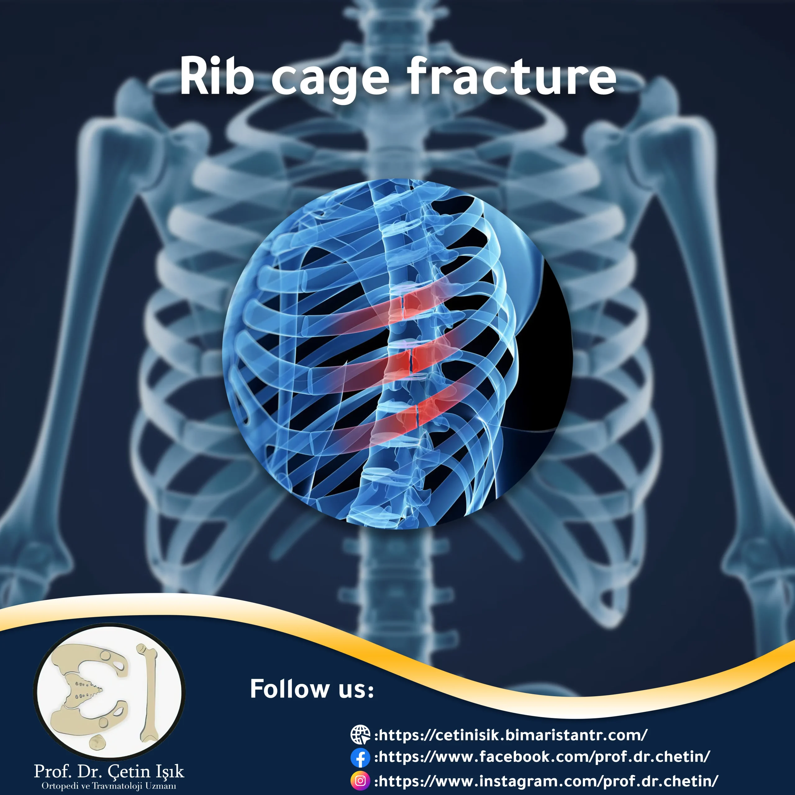 Rib cage fracture - ways to treat it without surgery