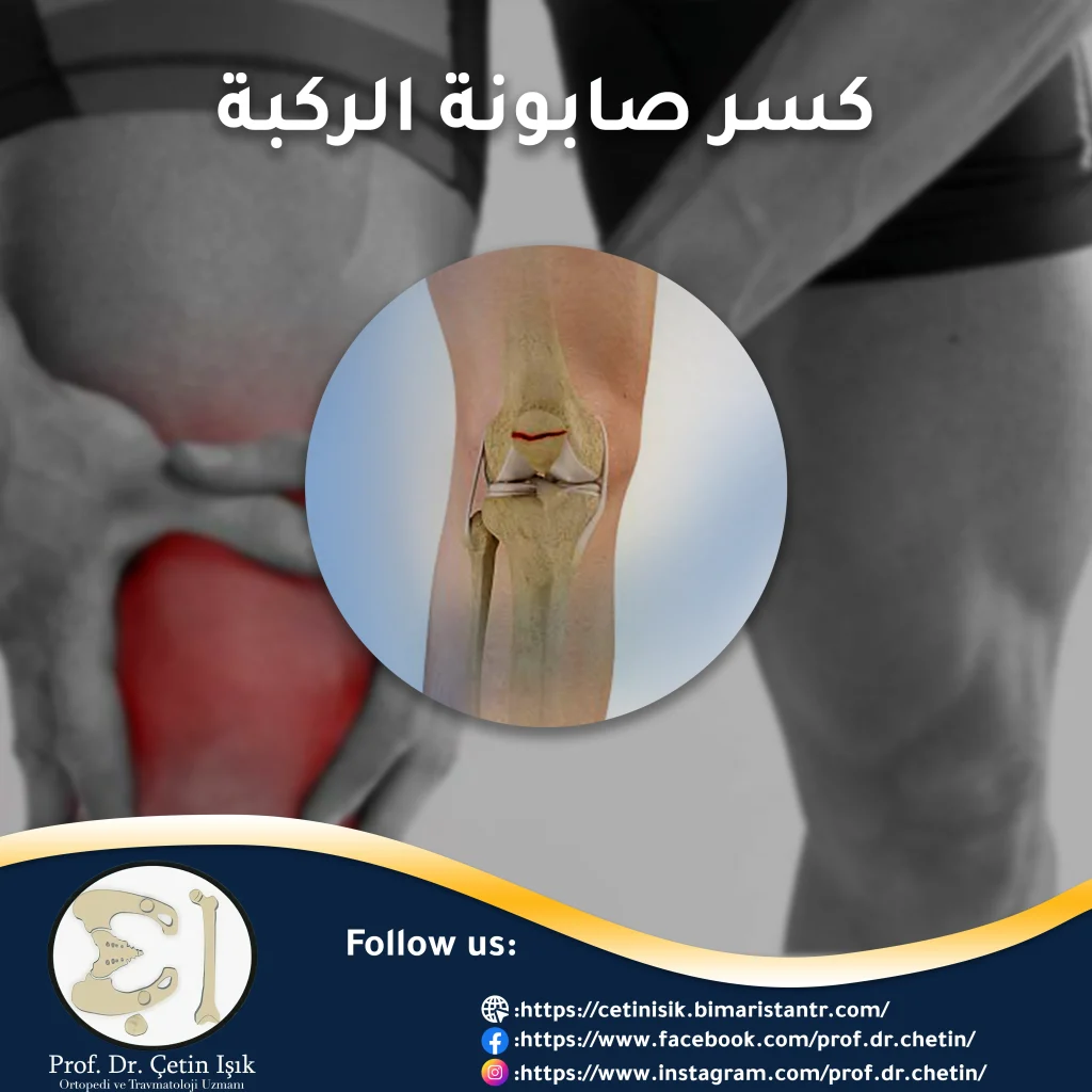 kneecap fracture; From diagnosis to treatment