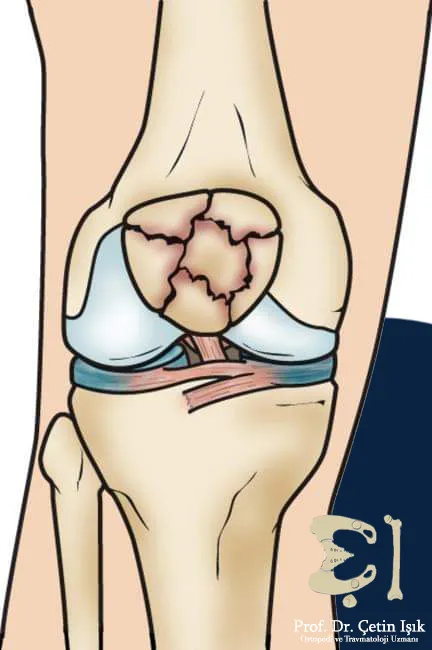 A comminuted kneecap fracture, in which the kneecap bone turns into bone fragments