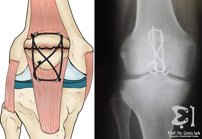 The transverse kneecap fracture was fixed to the patellar tendon by wires and screws in the form of a number 8